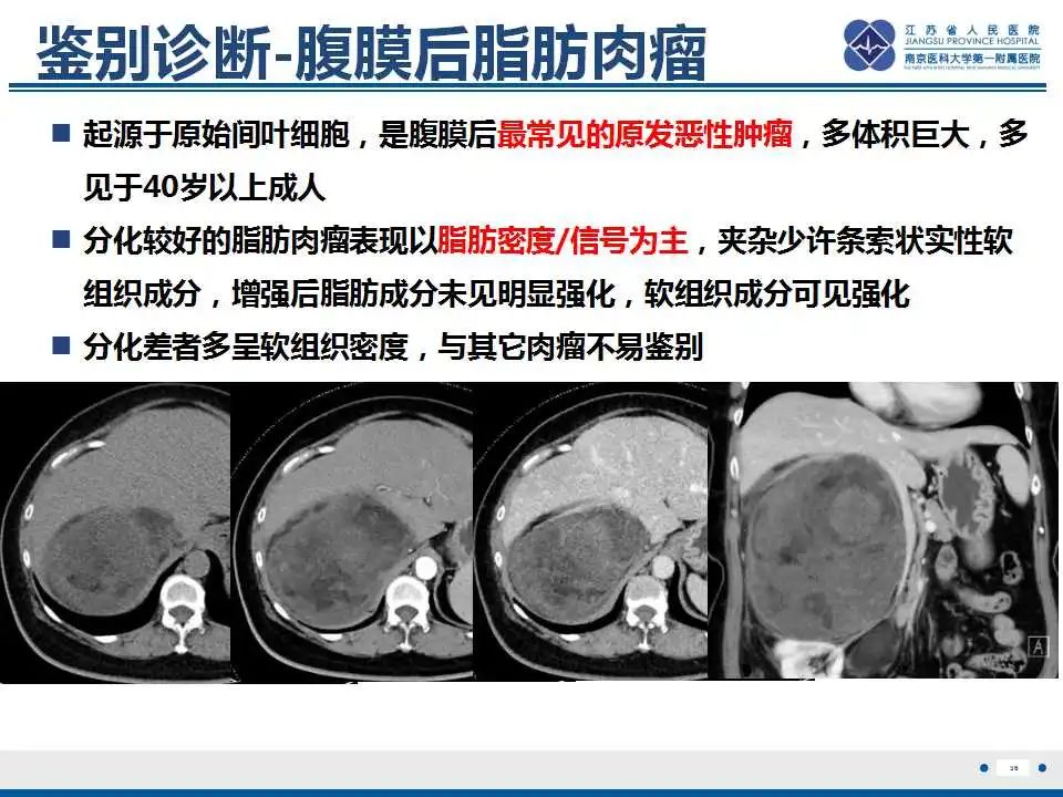 影像PPT - 【PPT】腹膜后平滑肌肉瘤-37