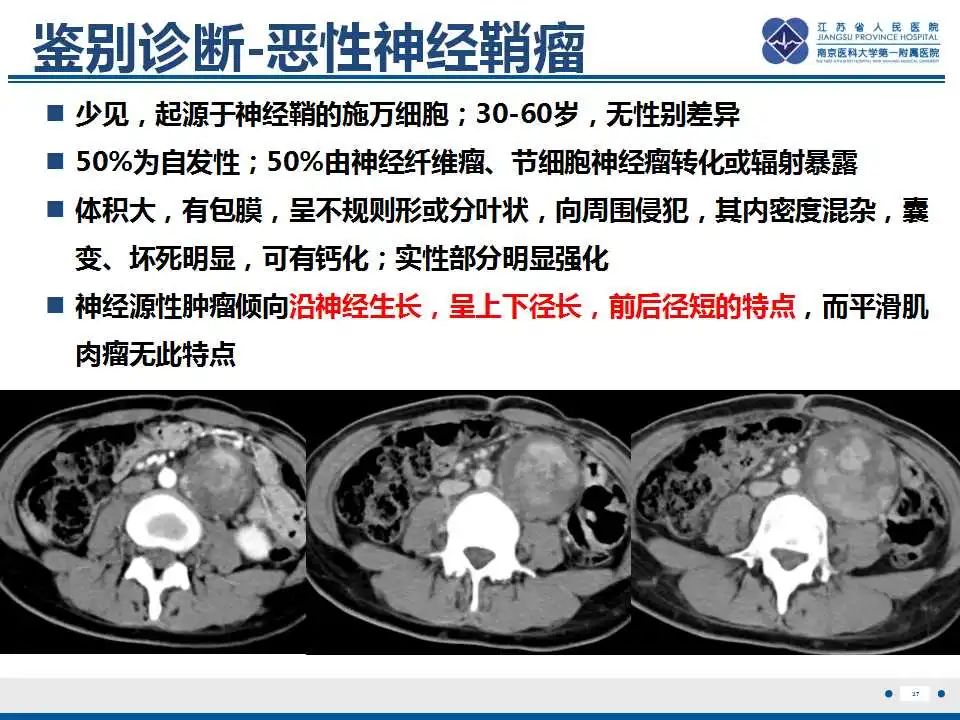 影像PPT - 【PPT】腹膜后平滑肌肉瘤-38