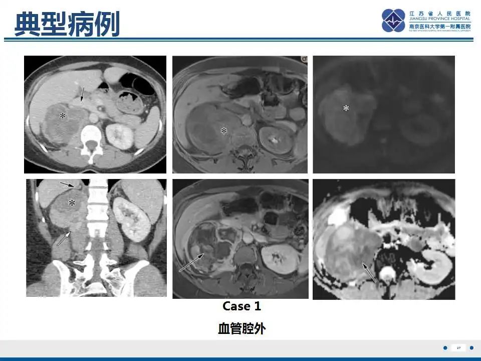 影像PPT - 【PPT】腹膜后平滑肌肉瘤-28