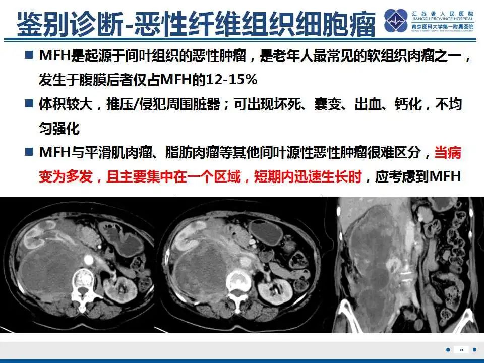 影像PPT - 【PPT】腹膜后平滑肌肉瘤-39