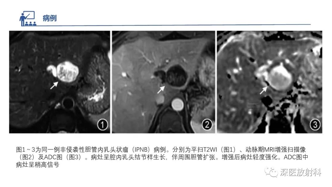 影像PPT - 【PPT】胆管导管内乳头状肿瘤:利用MRI评估浸润性和长期预后-31