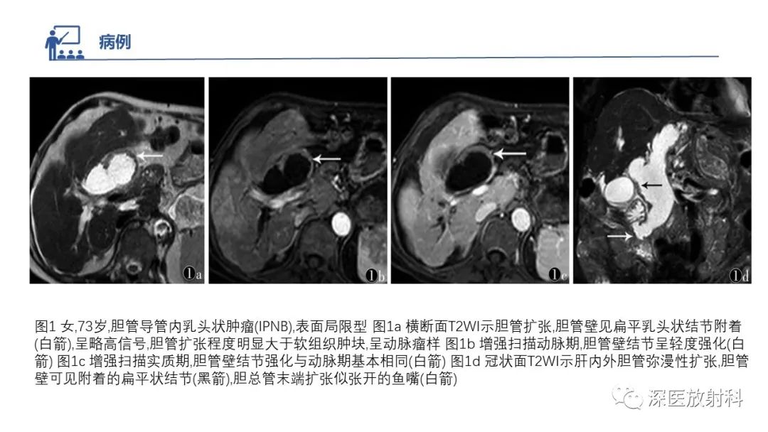 影像PPT - 【PPT】胆管导管内乳头状肿瘤:利用MRI评估浸润性和长期预后-30