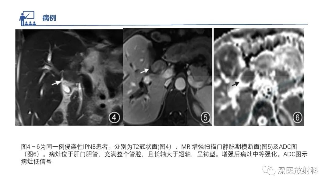 影像PPT - 【PPT】胆管导管内乳头状肿瘤:利用MRI评估浸润性和长期预后-32