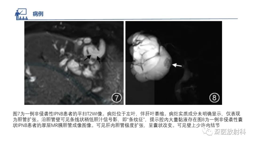 影像PPT - 【PPT】胆管导管内乳头状肿瘤:利用MRI评估浸润性和长期预后-33