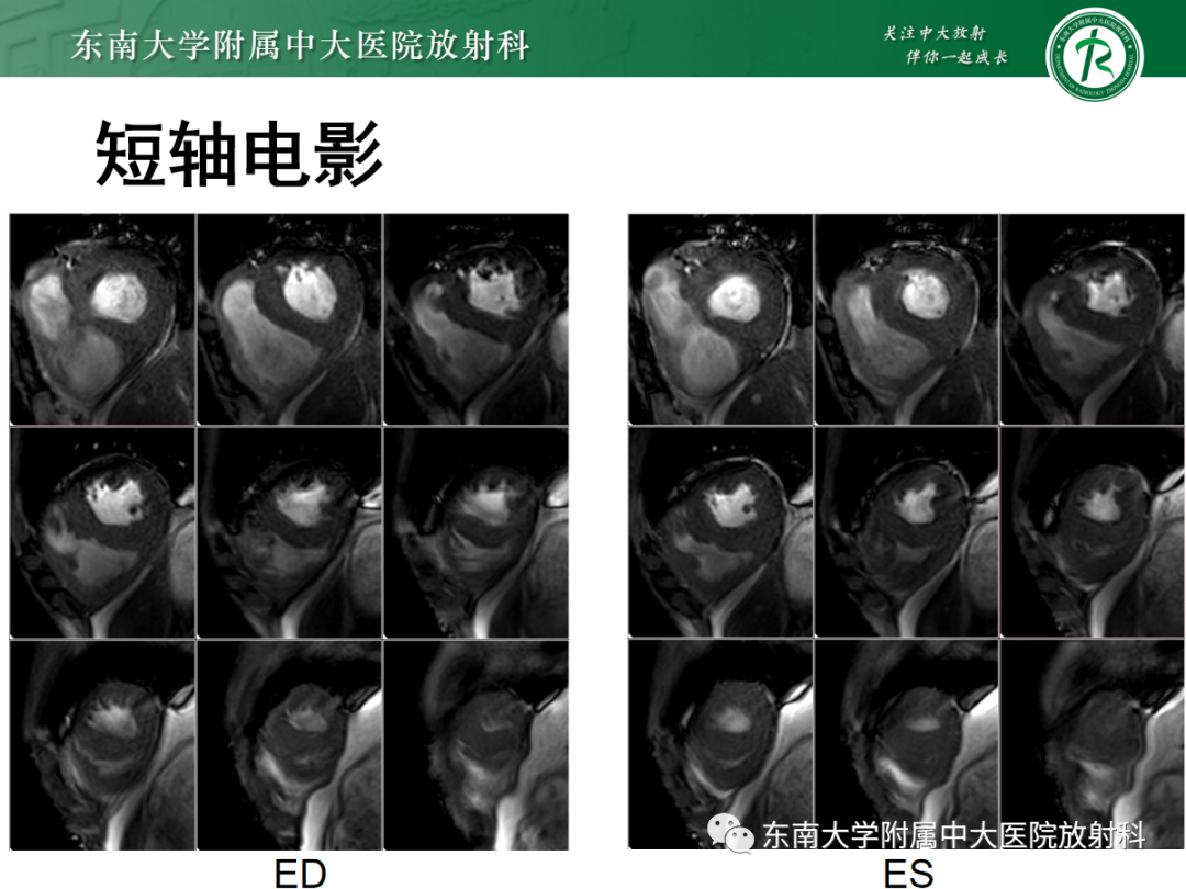 影像PPT - 【PPT】心肌淀粉样变-2