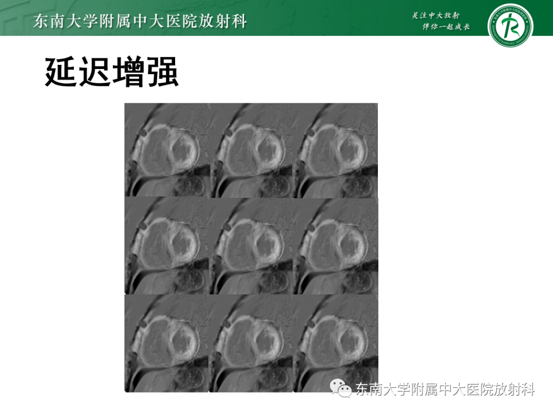 影像PPT - 【PPT】心肌淀粉样变-5