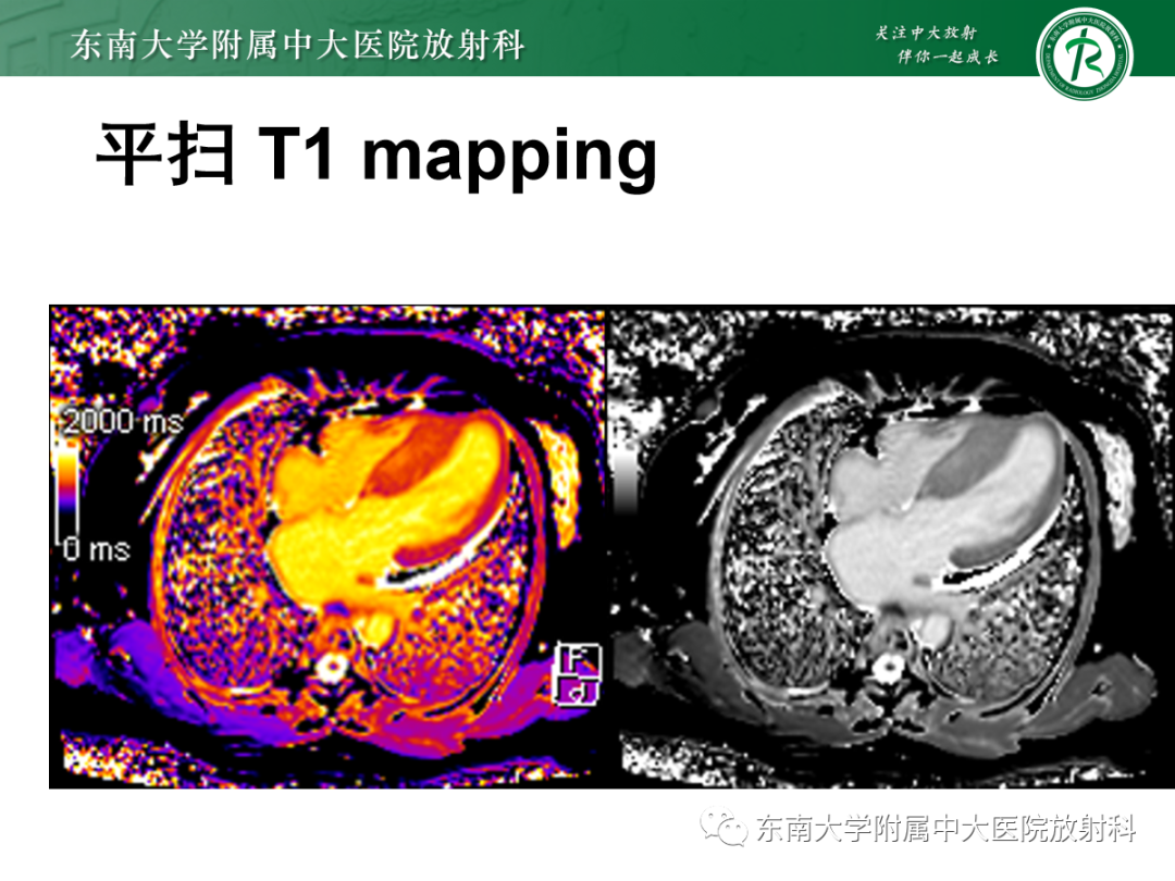 影像PPT - 【PPT】心肌淀粉样变-16