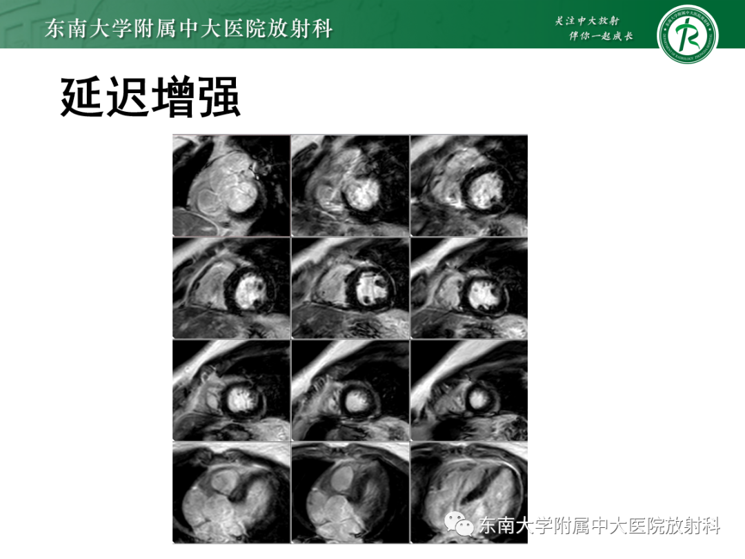 影像PPT - 【PPT】心肌淀粉样变-12