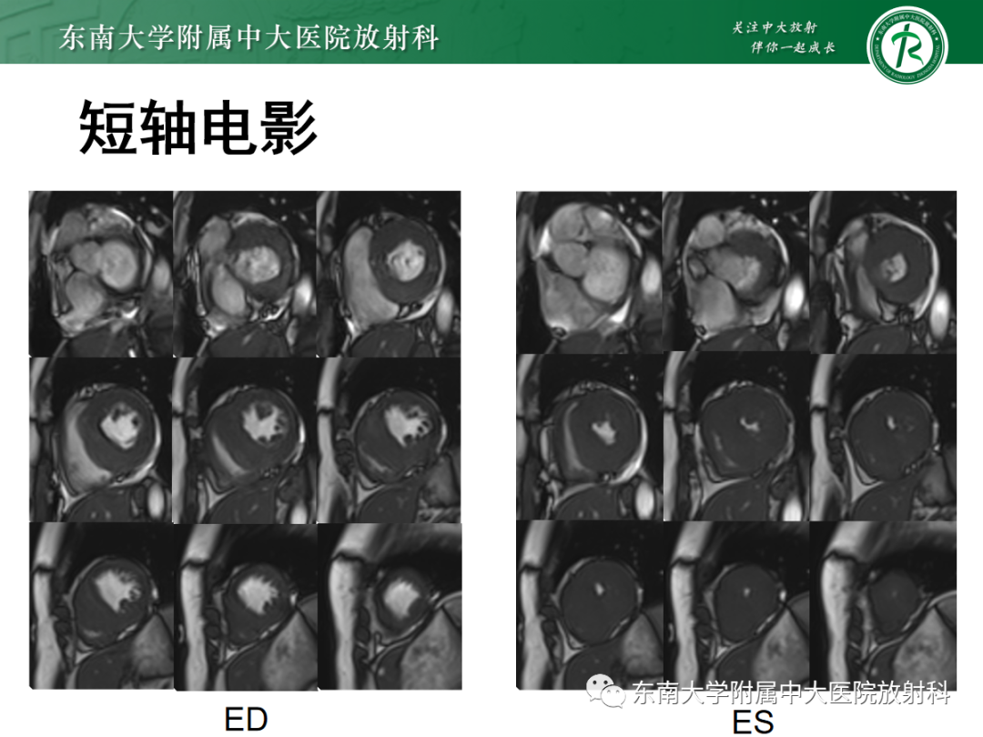 影像PPT - 【PPT】心肌淀粉样变-15