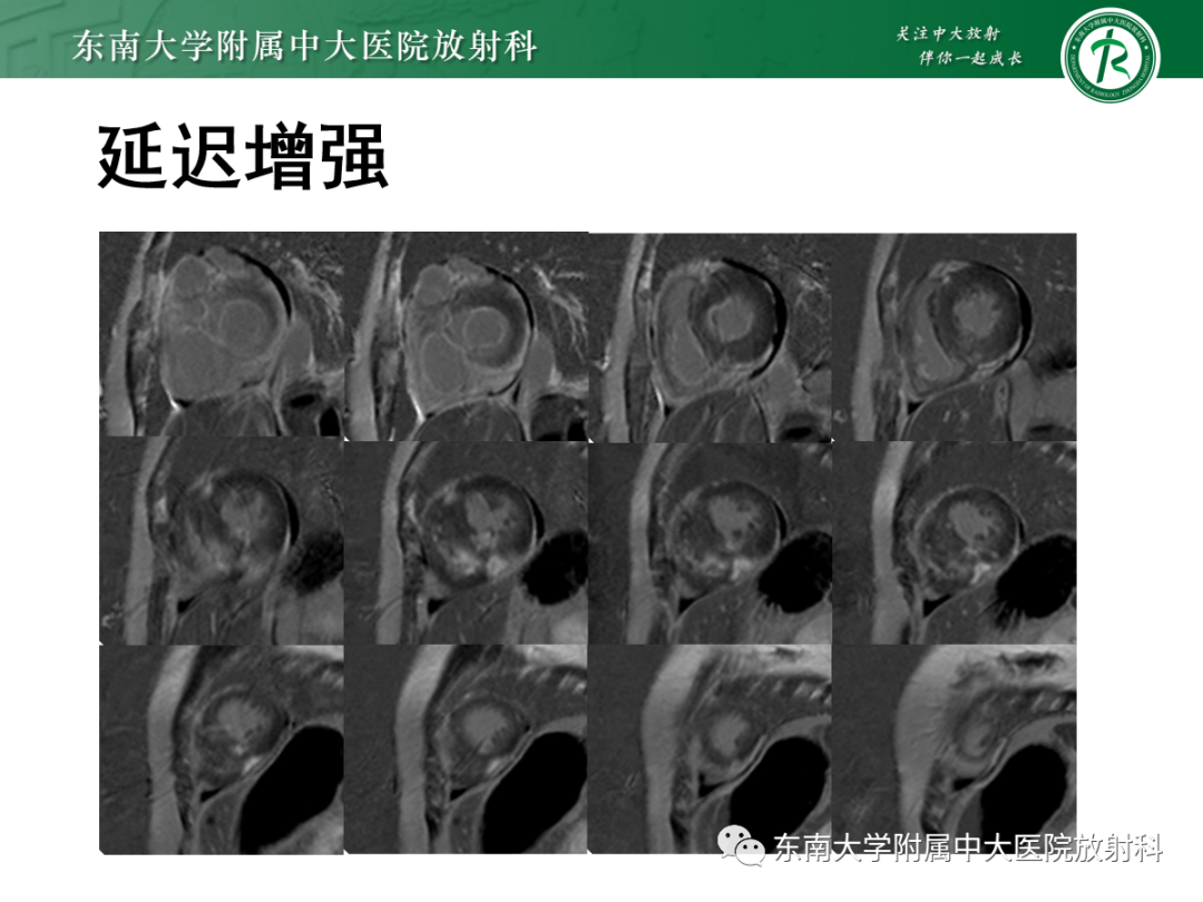 影像PPT - 【PPT】心肌淀粉样变-17
