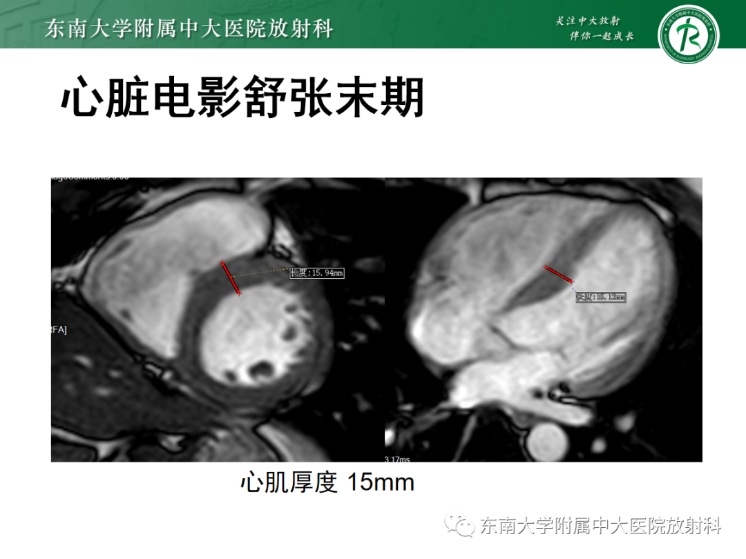 影像PPT - 【PPT】心肌淀粉样变-10