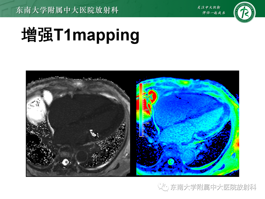 影像PPT - 【PPT】心肌淀粉样变-4