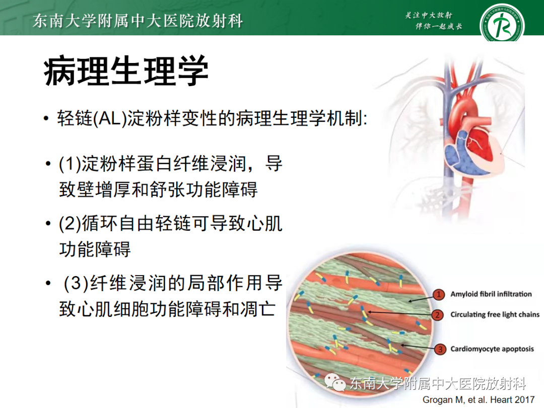 影像PPT - 【PPT】心肌淀粉样变-28