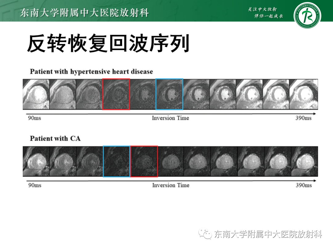 影像PPT - 【PPT】心肌淀粉样变-35