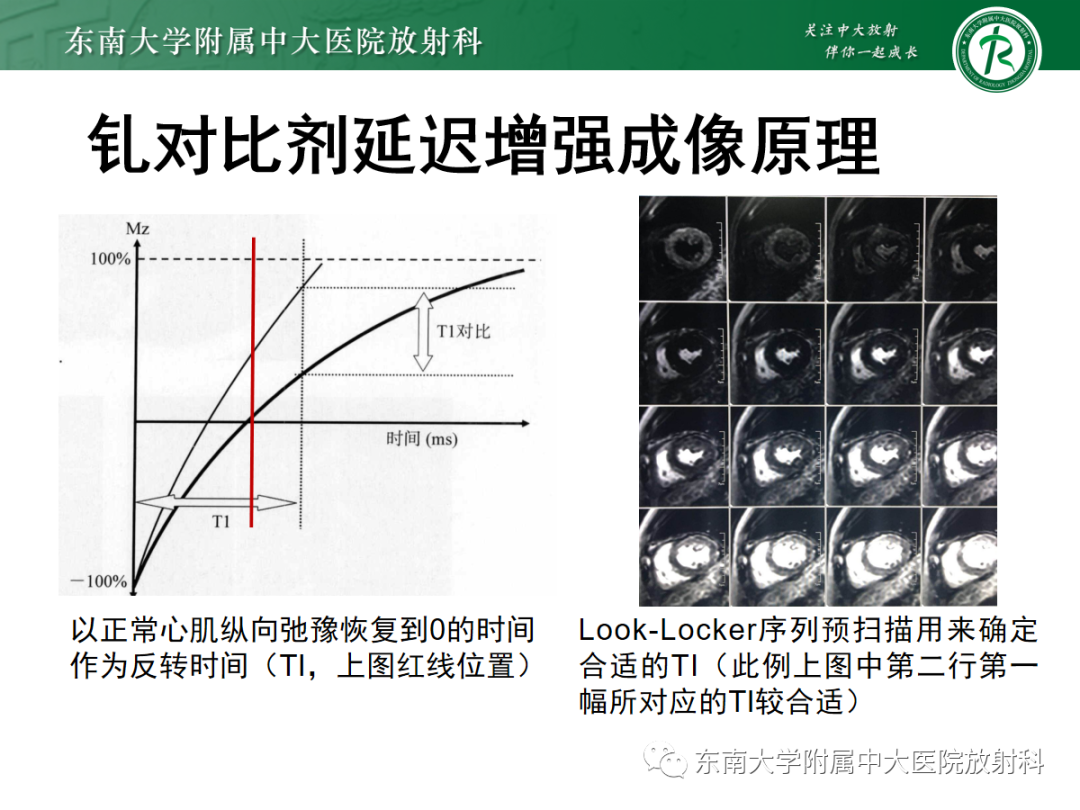 影像PPT - 【PPT】心肌淀粉样变-34
