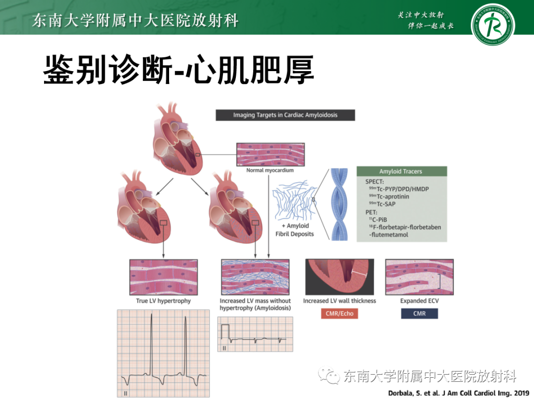影像PPT - 【PPT】心肌淀粉样变-39