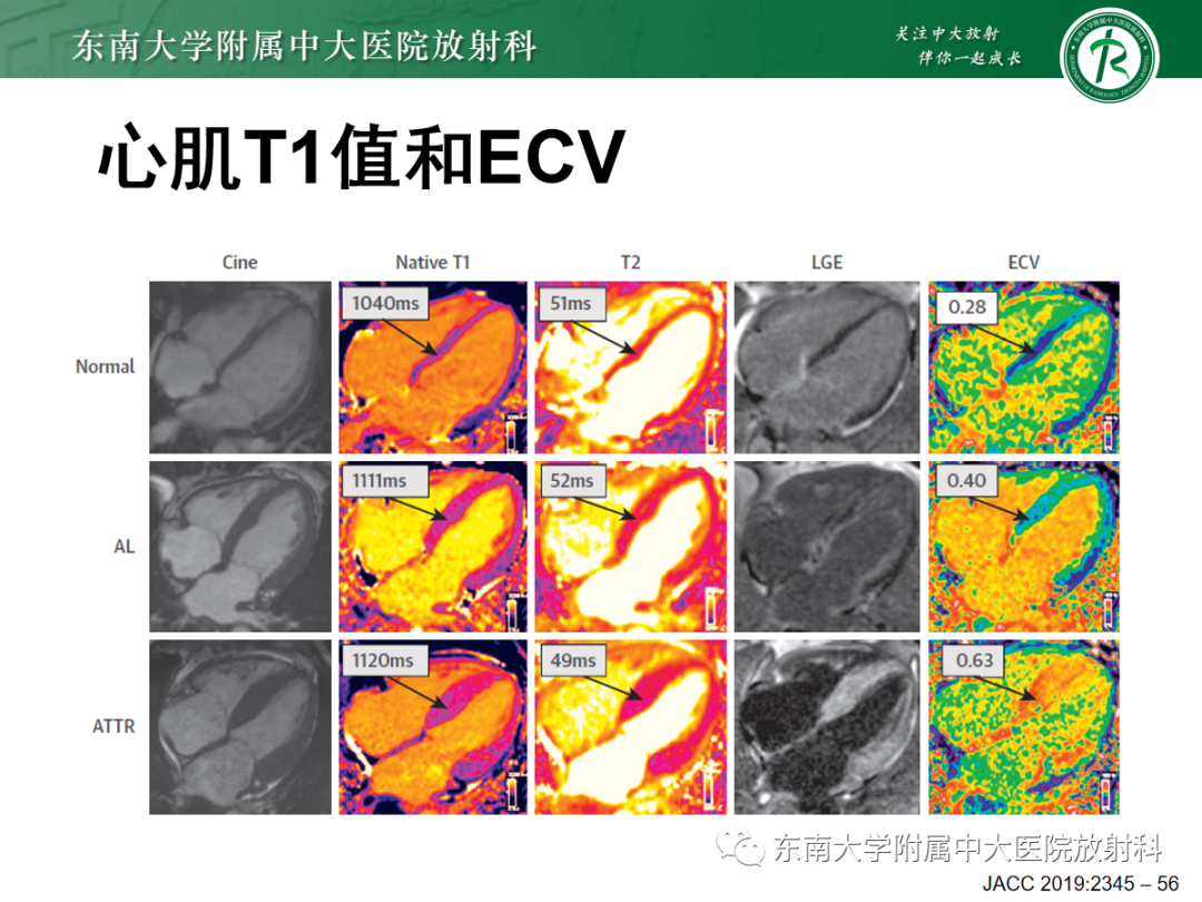 影像PPT - 【PPT】心肌淀粉样变-38