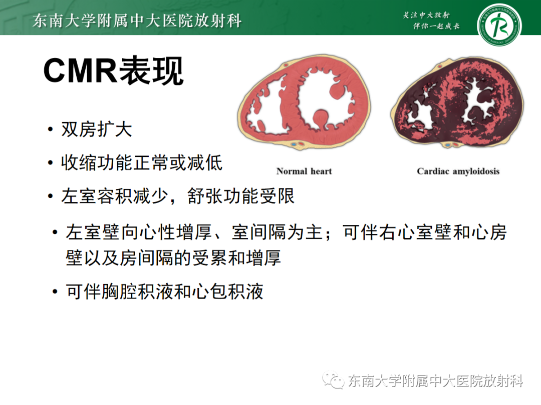 影像PPT - 【PPT】心肌淀粉样变-32