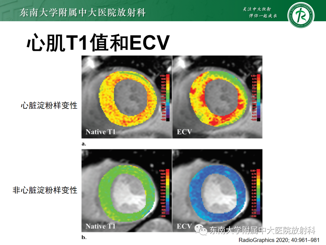 影像PPT - 【PPT】心肌淀粉样变-37
