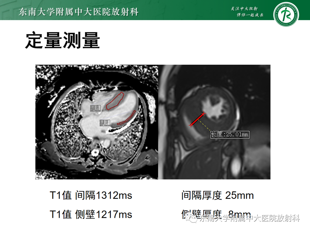 影像PPT - 【PPT】心肌淀粉样变-18