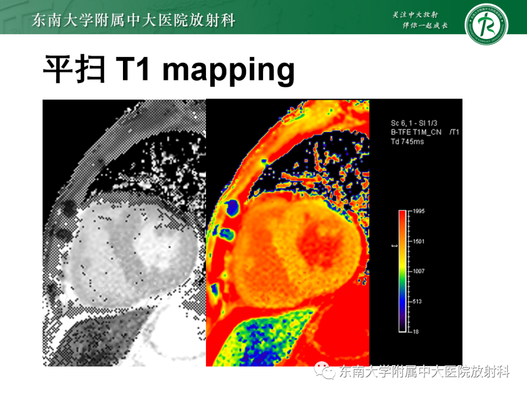影像PPT - 【PPT】心肌淀粉样变-3