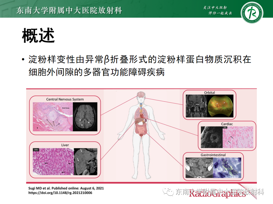 影像PPT - 【PPT】心肌淀粉样变-24