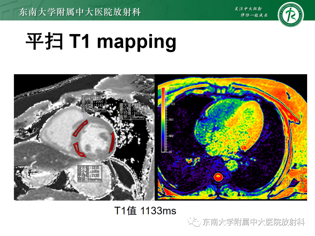 影像PPT - 【PPT】心肌淀粉样变-11