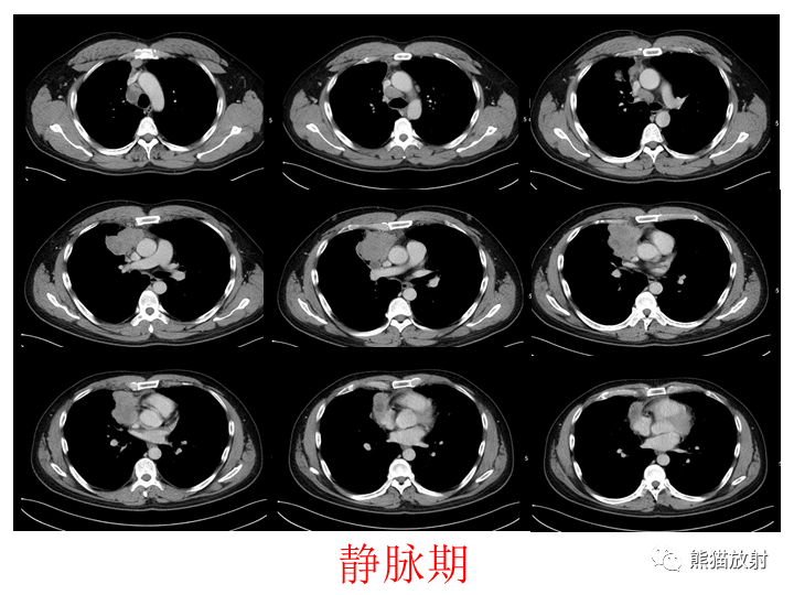 影像PPT - 【病例】纵隔淋巴瘤2例CT影像-5