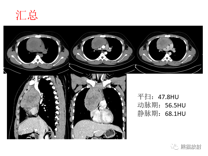 影像PPT - 【病例】纵隔淋巴瘤2例CT影像-14