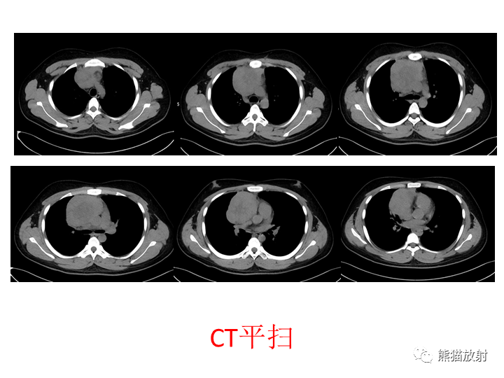 影像PPT - 【病例】纵隔淋巴瘤2例CT影像-10