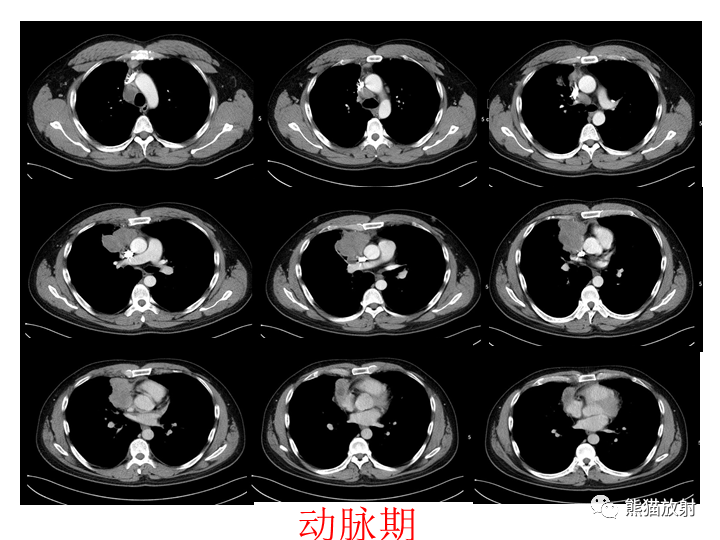 影像PPT - 【病例】纵隔淋巴瘤2例CT影像-4