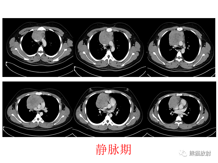 影像PPT - 【病例】纵隔淋巴瘤2例CT影像-12