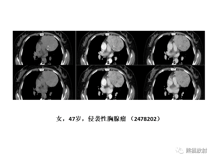 影像PPT - 【病例】纵隔淋巴瘤2例CT影像-24