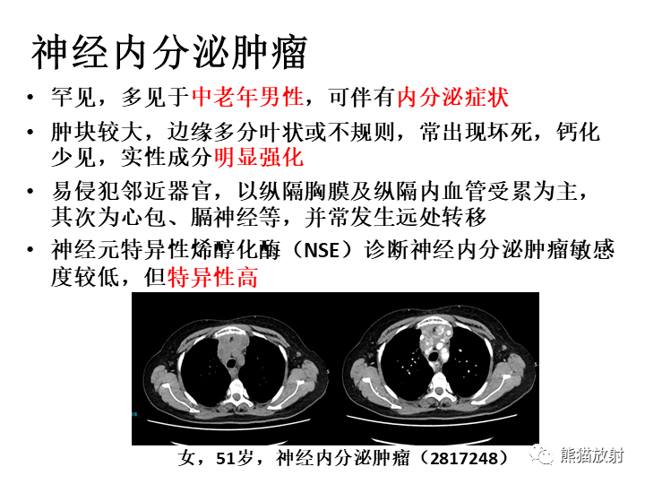 影像PPT - 【病例】纵隔淋巴瘤2例CT影像-27