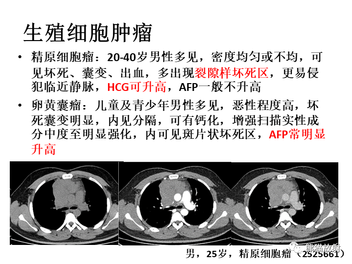 影像PPT - 【病例】纵隔淋巴瘤2例CT影像-26