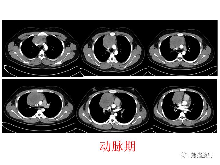 影像PPT - 【病例】纵隔淋巴瘤2例CT影像-2