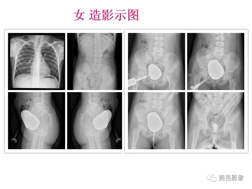 影像PPT - 【PPT】儿童膀胱造影流程及常见疾病诊断-7