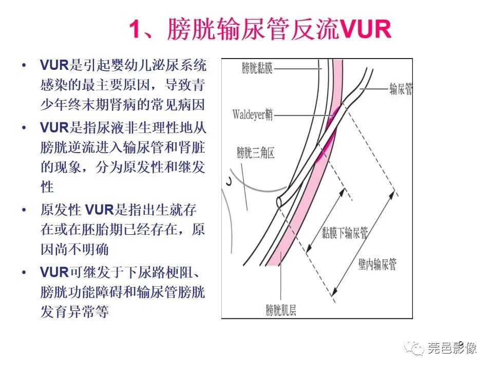 影像PPT - 【PPT】儿童膀胱造影流程及常见疾病诊断-9