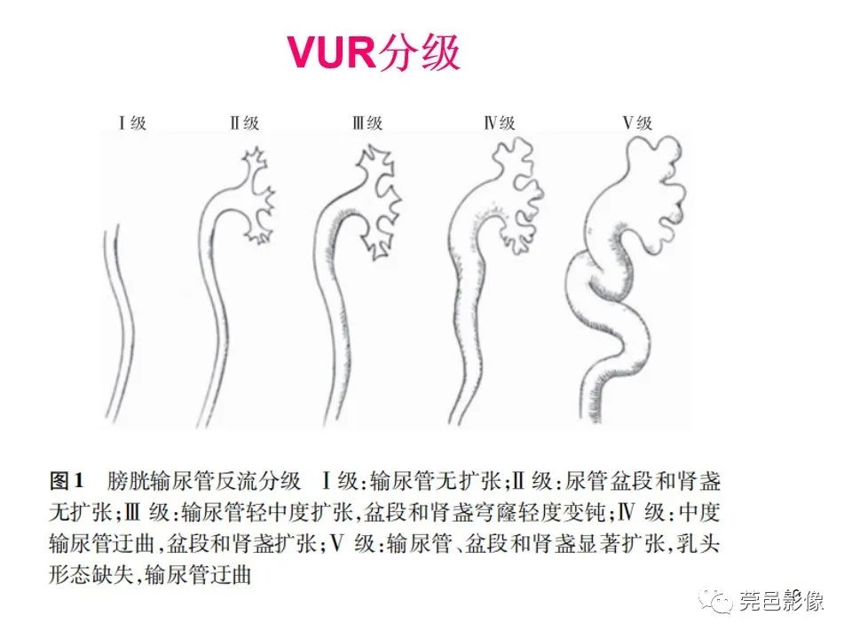 影像PPT - 【PPT】儿童膀胱造影流程及常见疾病诊断-10