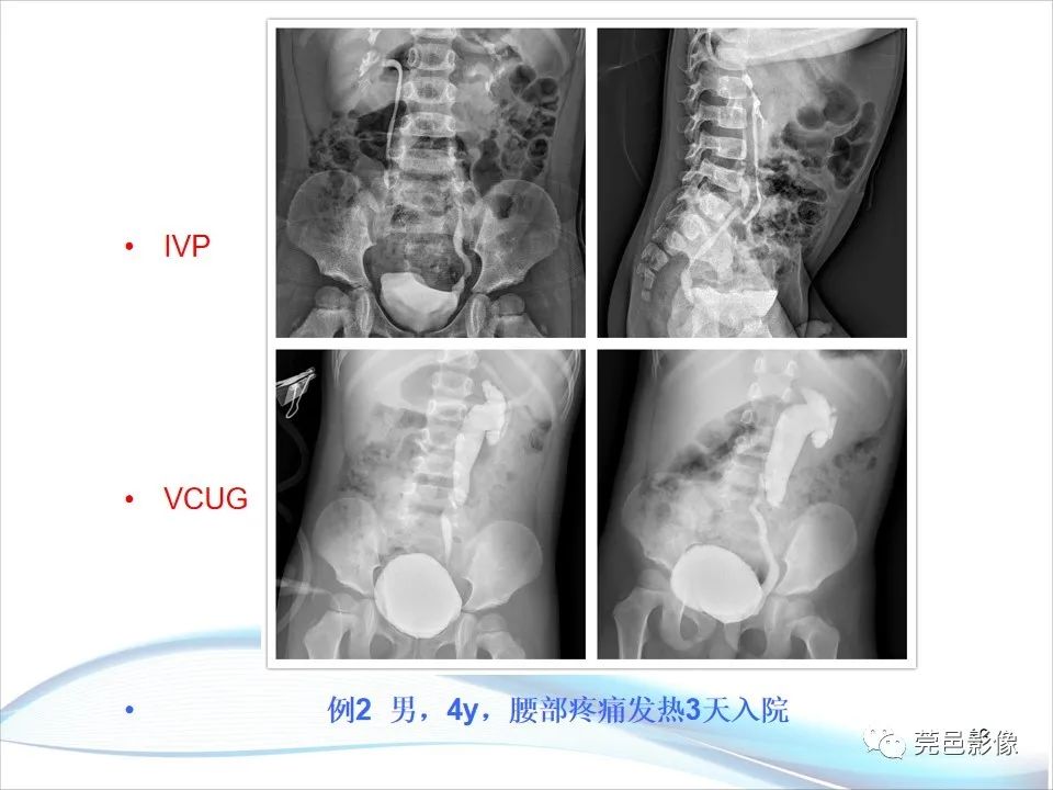 影像PPT - 【PPT】儿童膀胱造影流程及常见疾病诊断-13