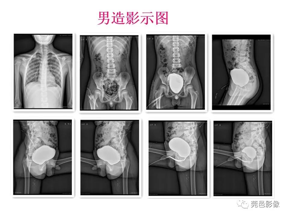 影像PPT - 【PPT】儿童膀胱造影流程及常见疾病诊断-6