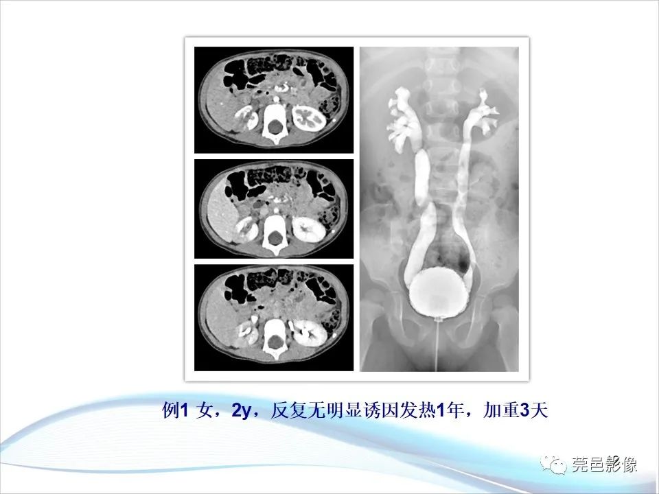 影像PPT - 【PPT】儿童膀胱造影流程及常见疾病诊断-12