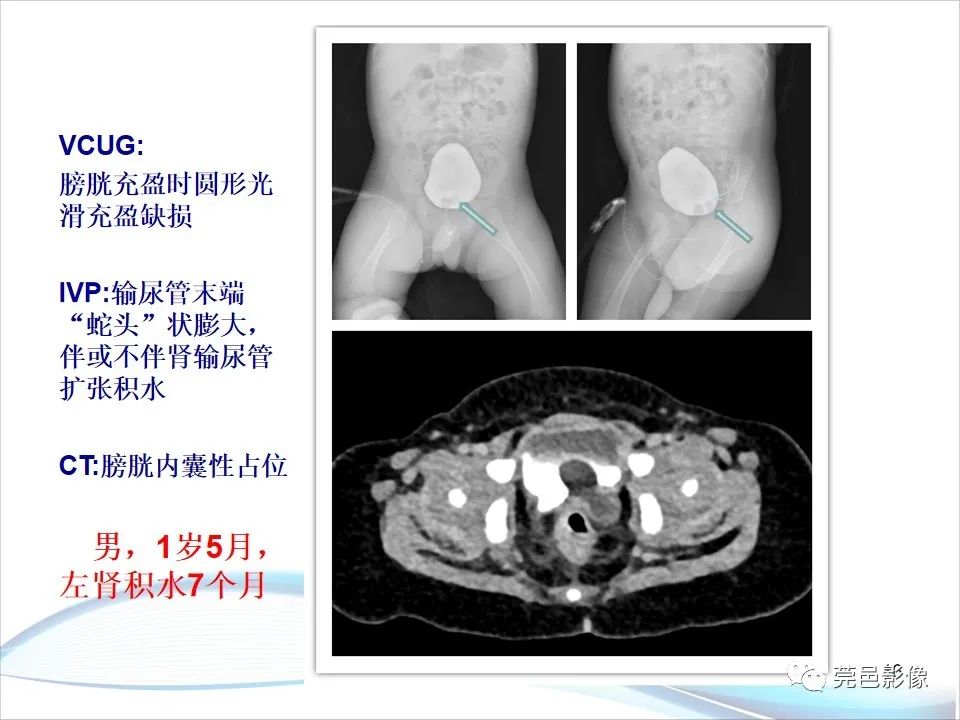 影像PPT - 【PPT】儿童膀胱造影流程及常见疾病诊断-16