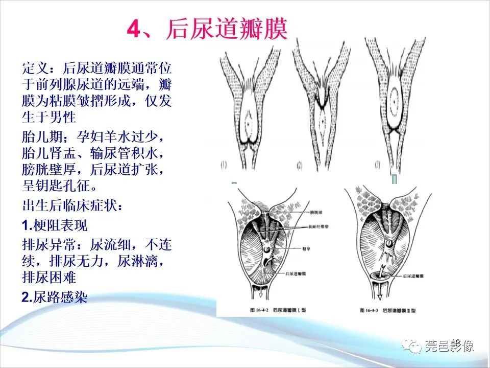 影像PPT - 【PPT】儿童膀胱造影流程及常见疾病诊断-18