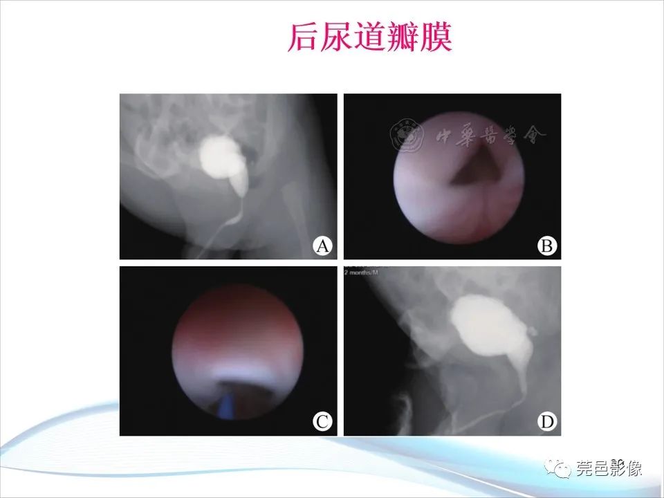 影像PPT - 【PPT】儿童膀胱造影流程及常见疾病诊断-20