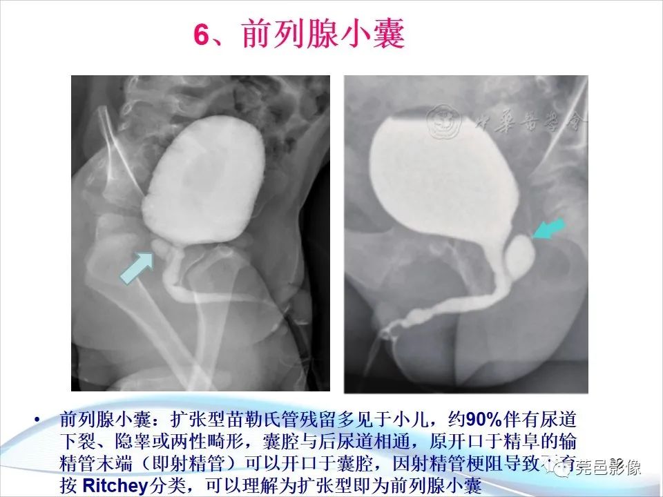影像PPT - 【PPT】儿童膀胱造影流程及常见疾病诊断-22