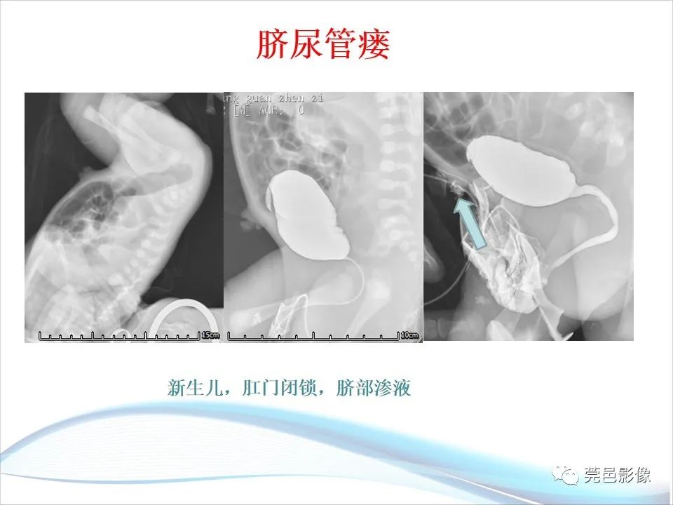 影像PPT - 【PPT】儿童膀胱造影流程及常见疾病诊断-25