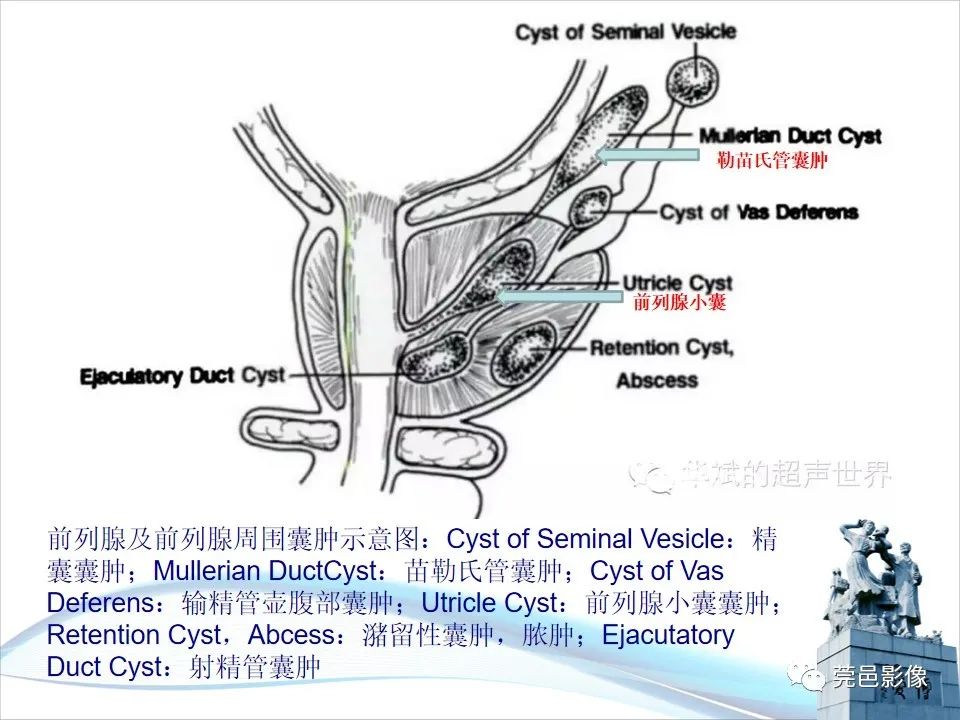 影像PPT - 【PPT】儿童膀胱造影流程及常见疾病诊断-23
