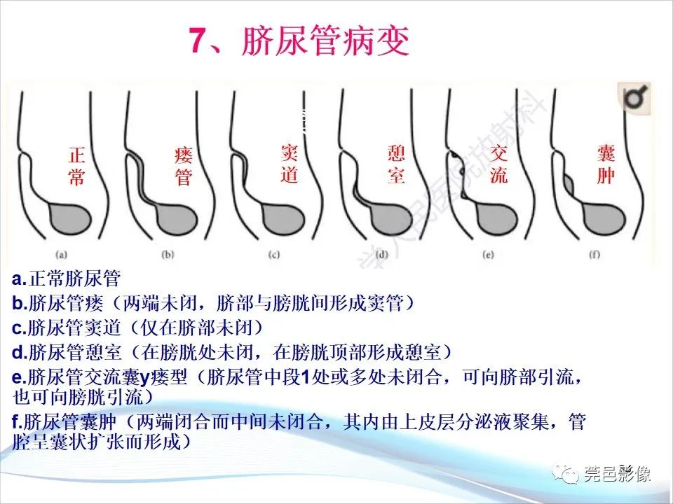 影像PPT - 【PPT】儿童膀胱造影流程及常见疾病诊断-24