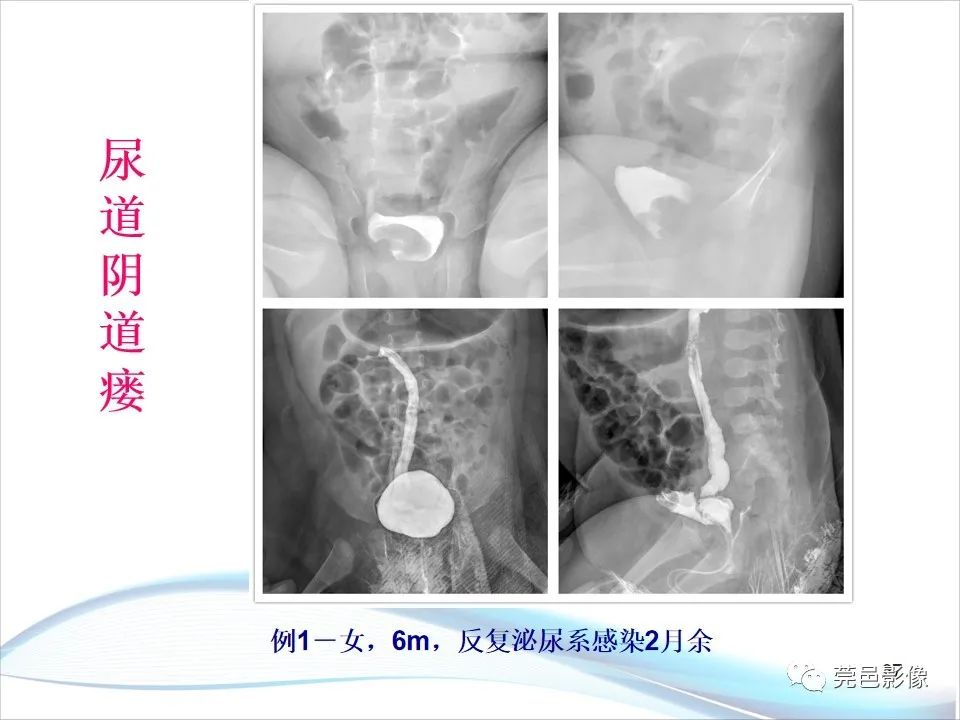 影像PPT - 【PPT】儿童膀胱造影流程及常见疾病诊断-27